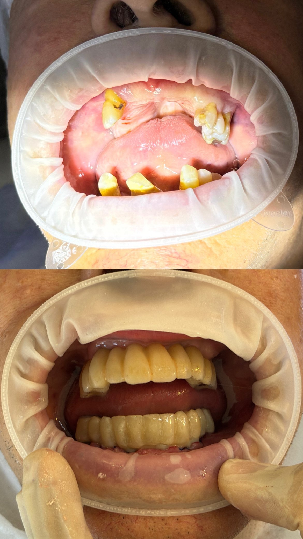 Antes y después — Daniel Freytes